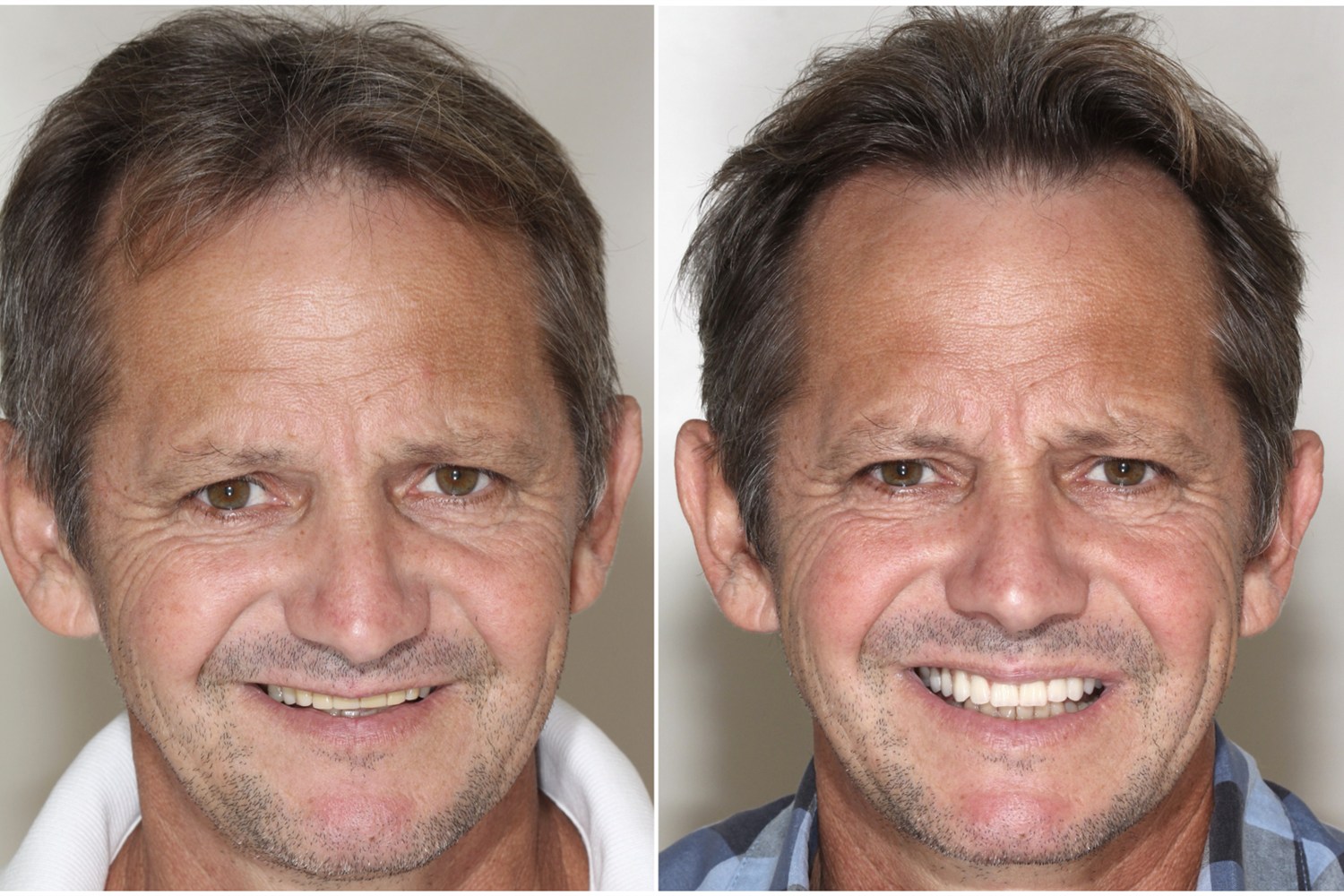 Before and after: man rehabilitated with fixed teeth on implants