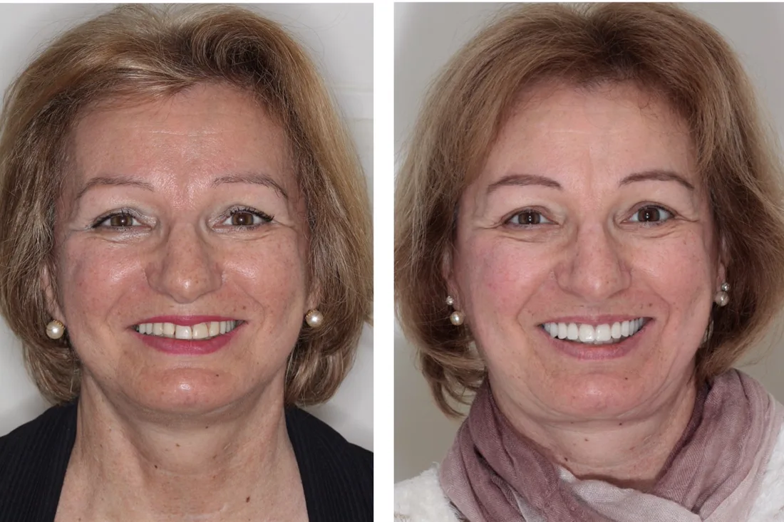 Before and after: patient rehabilitated with a fixed prosthesis on implants