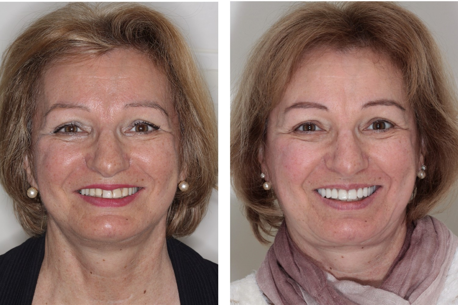 Before and after: patient rehabilitated with a fixed prosthesis on implants