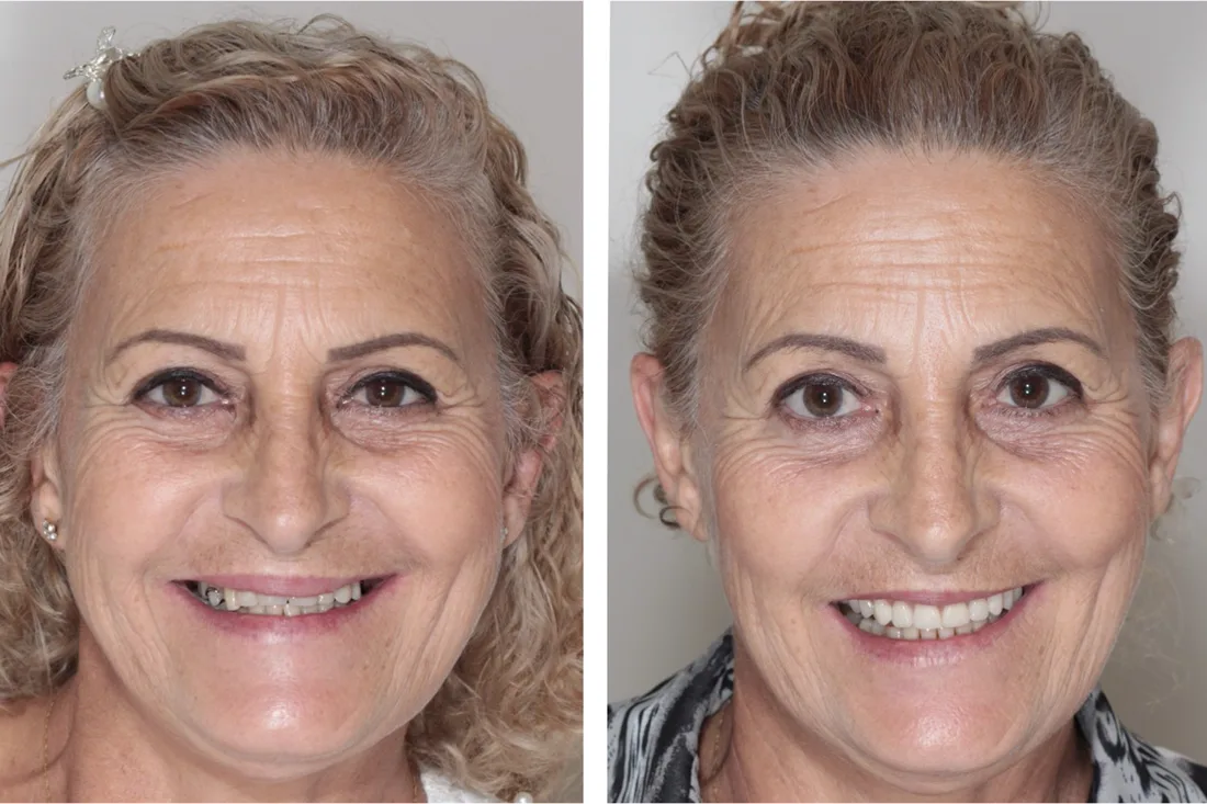 Before and after: full rehabilitation with fixed teeth