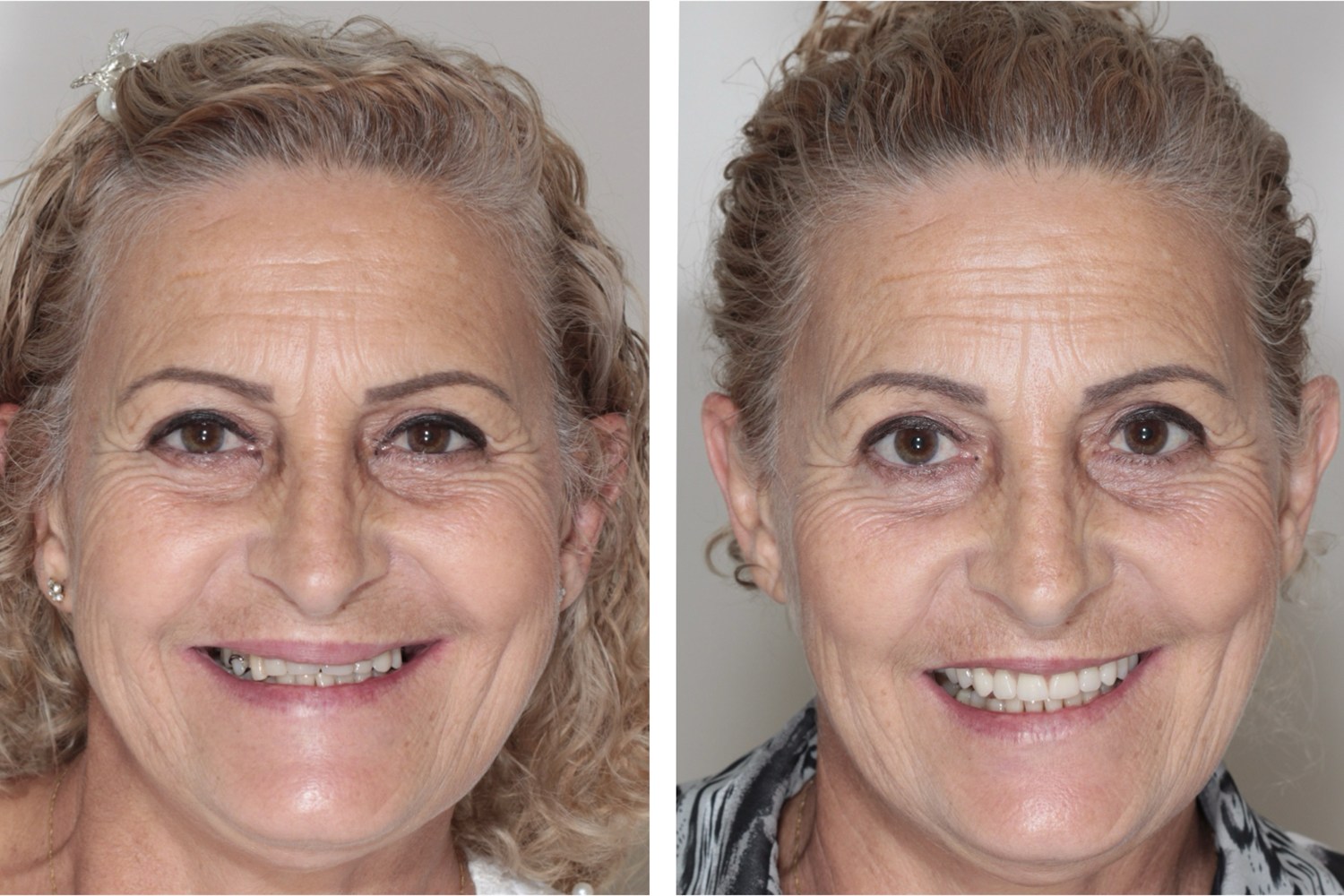 Before and after: full rehabilitation with fixed teeth