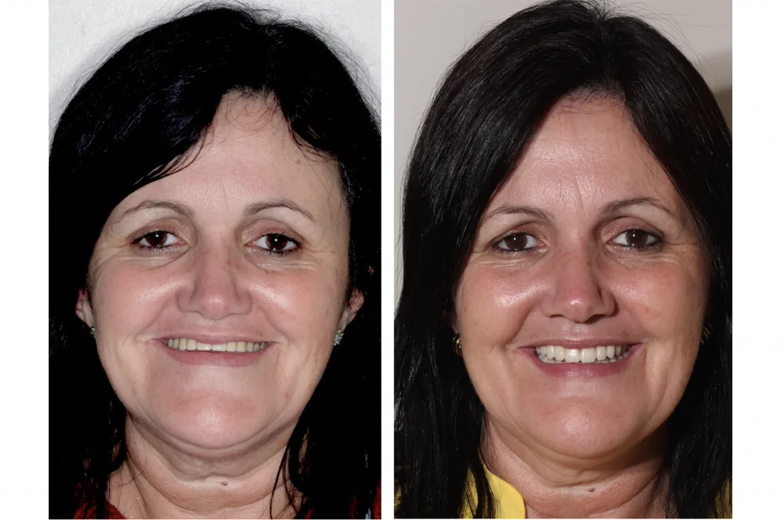 Before and after: smile restored with fixed teeth on implants