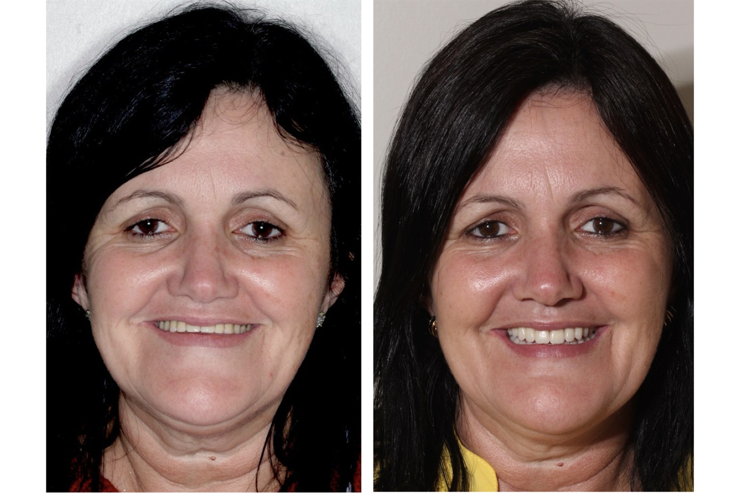 Before and after: smile restored with fixed teeth on implants