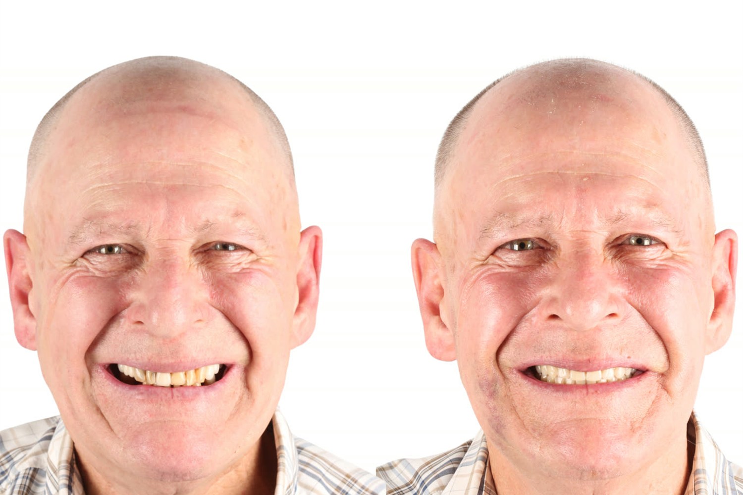 Before and after: patient who came from Canada to Brazil
