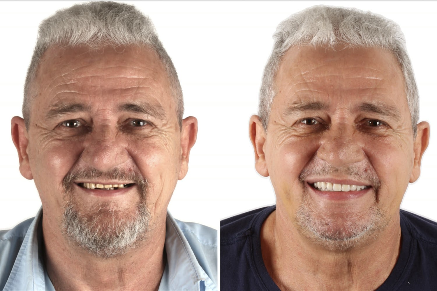 Before and after: case rehabilitated with the FaceFirst approach and zygomatic implants