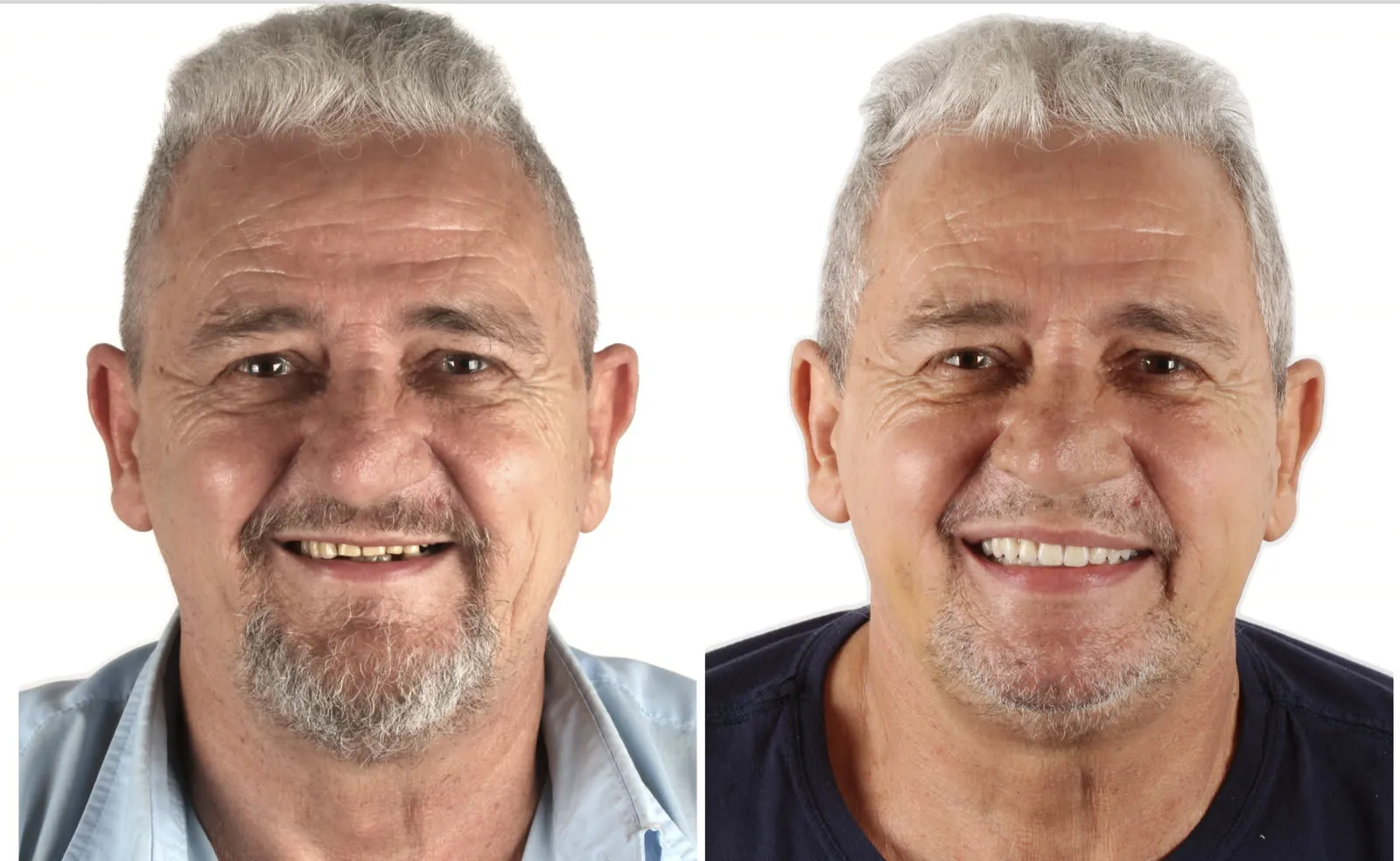 Antes e depois: caso reabilitado com a abordagem FaceFirst e implantes zigomáticos