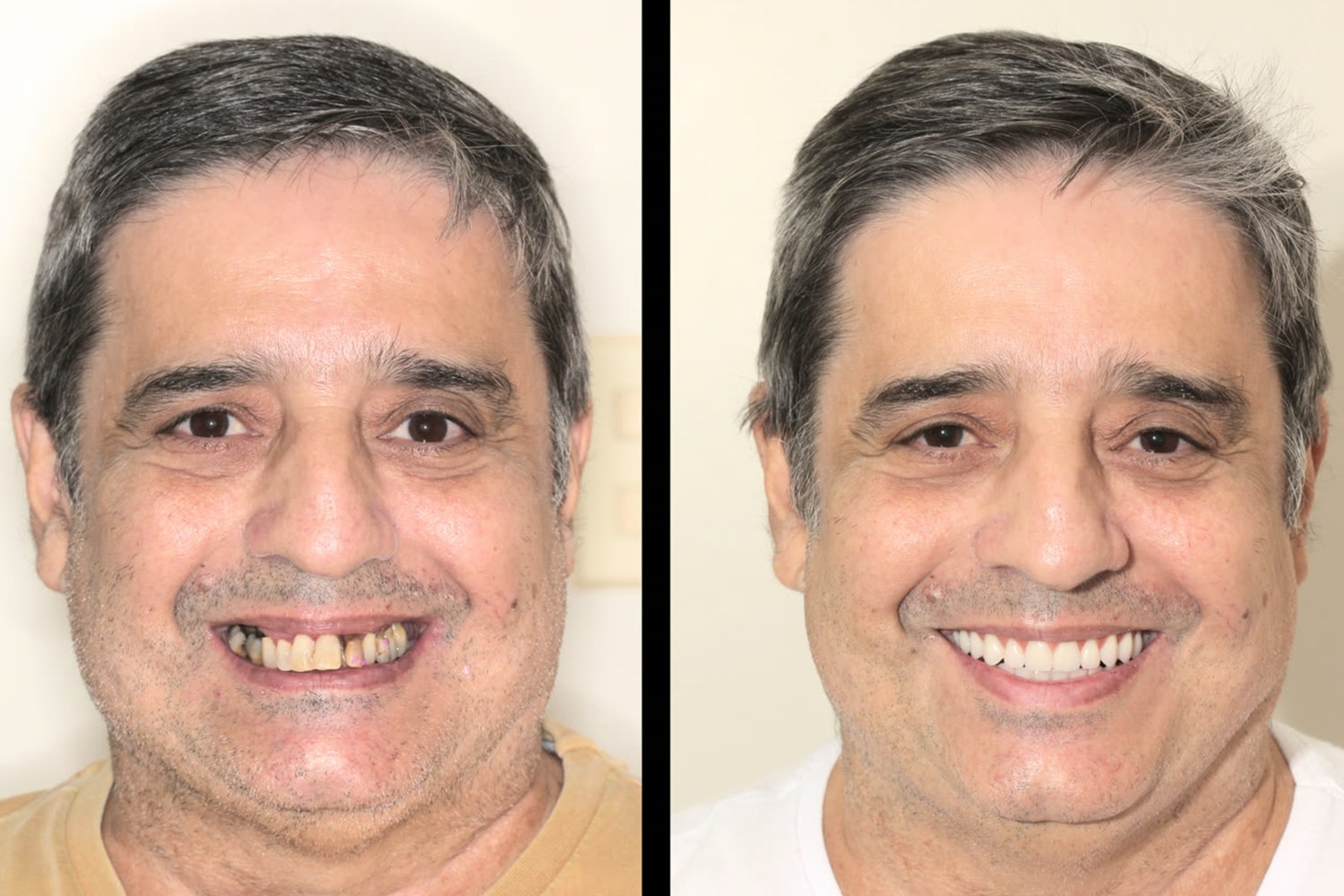 Before and after: rehabilitation with fixed teeth on implants