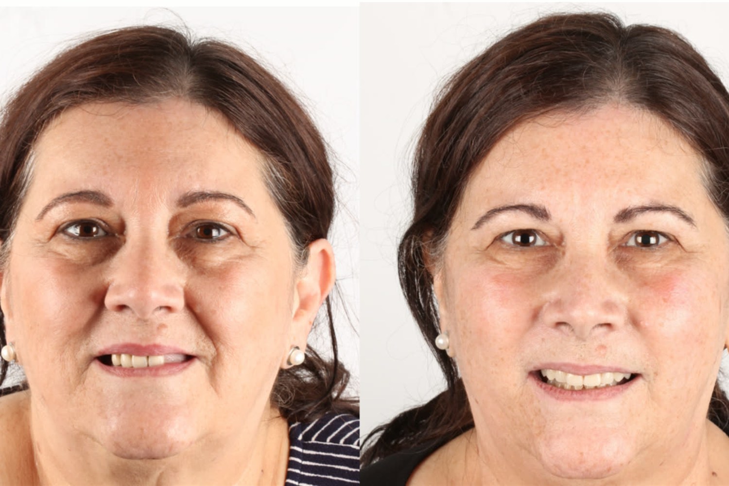Before and after: patient who came from the USA to Brazil