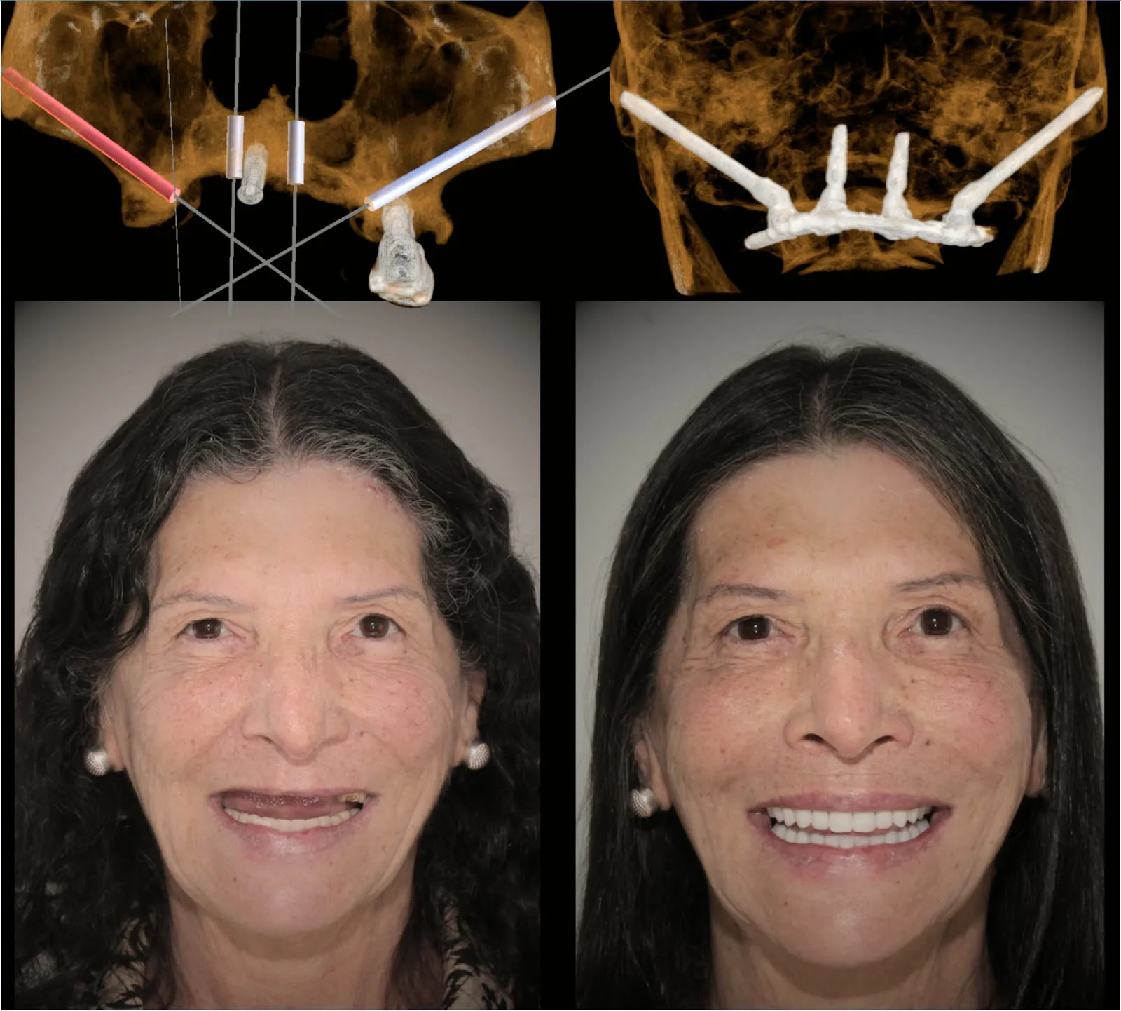 Antes e depois: implante zigomático com simulação e tomografia final