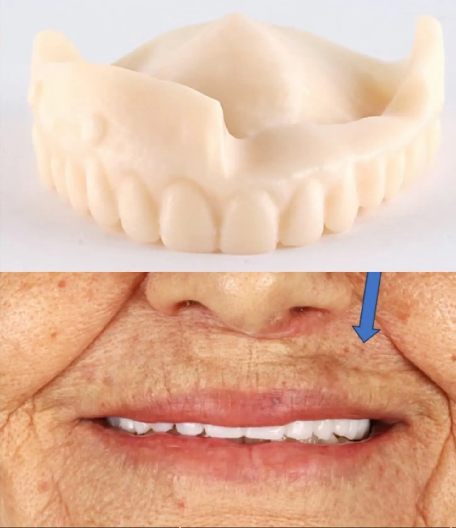 Teste diagnóstico: metade da flange removida desta cópia da dentadura — o lado sem flange afunda no rosto, a seta azul mostra a perda de suporte do lábio