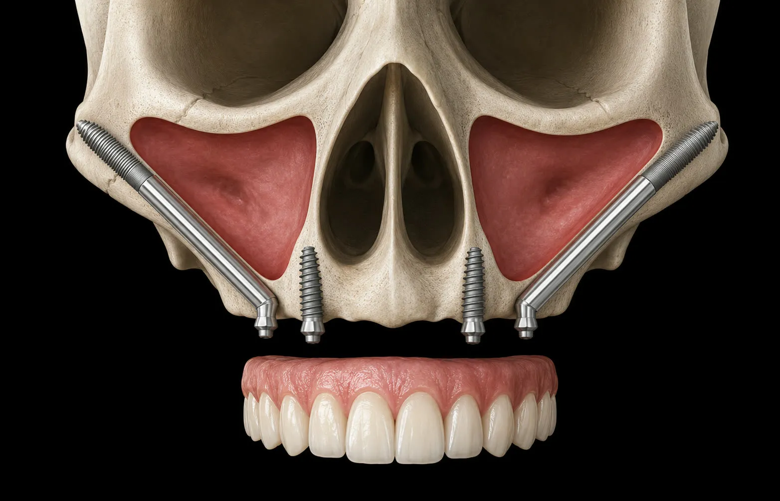 Ilustração anatômica: implantes zigomáticos ancorados no osso da maçã do rosto sustentando a prótese fixa