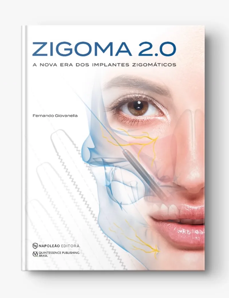Capa do livro ZIGOMA 2.0 — A Nova Era dos Implantes Zigomáticos, de Fernando Giovanella, Napoleão Editora
