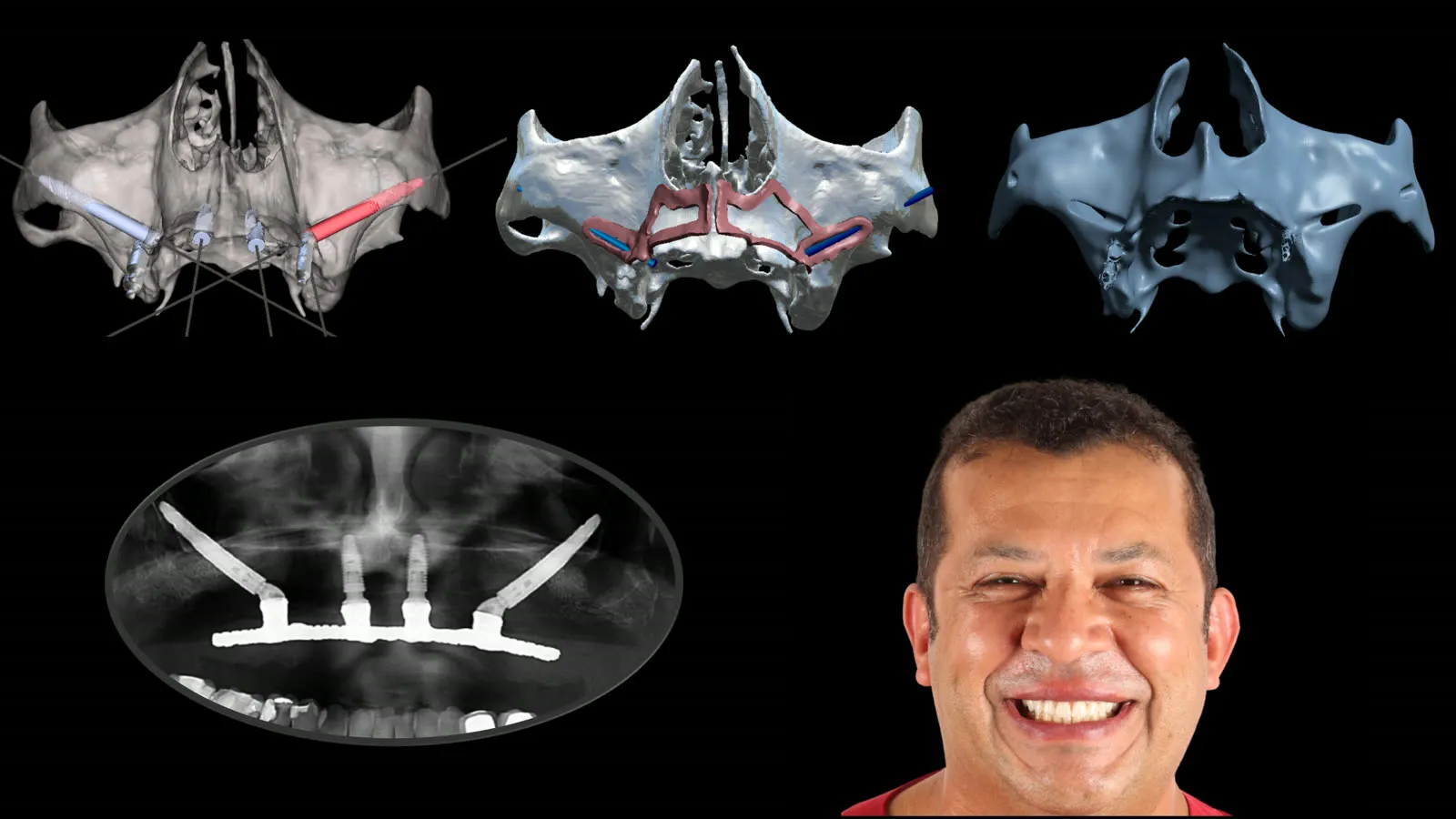 Caso completo: modelos virtuais, radiografia e o sorriso final do paciente