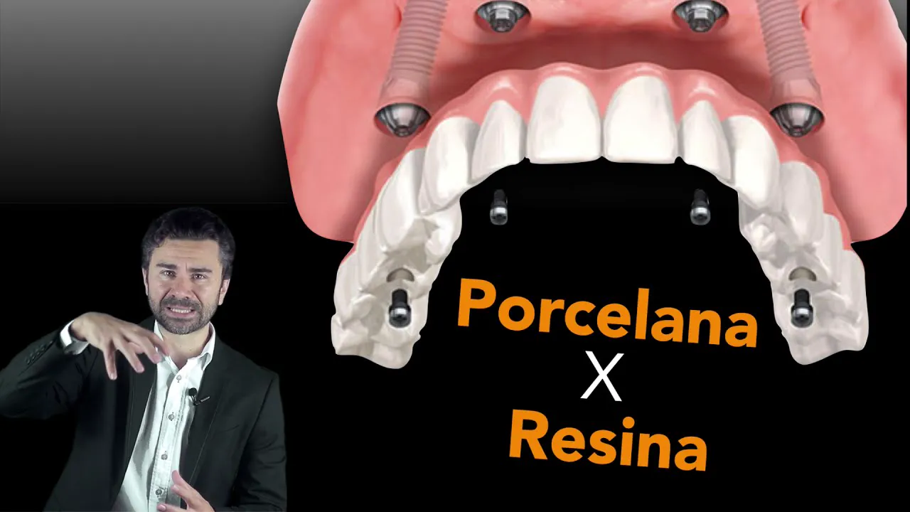 Vídeo: acrílico ou porcelana — Dr. Fernando explica